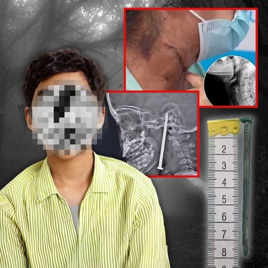 7-Year-Old Boy Gets 3-Inch Nail Lodged in His Brain in Freak Accident While Playing